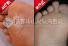 二氧化碳激光烧灼法 彻底根除鸡眼不复发