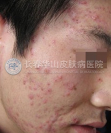 不同类型的青春痘症状大不相同