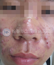 青春痘为何越治越重