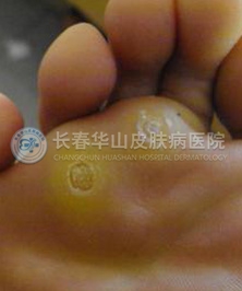 专家讲解鸡眼的症状