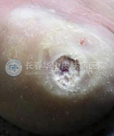 鸡眼该怎么治