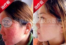 治愈青春痘 还皮肤美丽健康