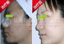 治好青春痘，从了爱美心